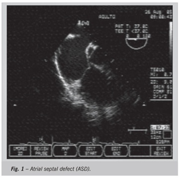 Percutaneous closure of atrial septal defect using transhepatic puncture