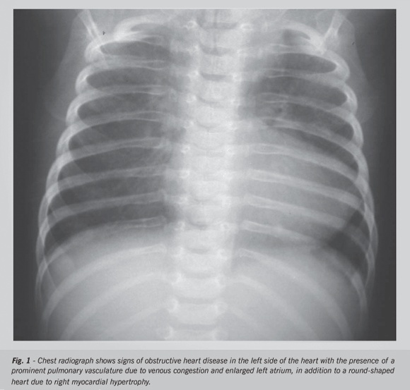 Case 2/2006 – three-year-old child with subaortic stenosis, mitral stenosis due to parachute mitral valve, supravalvular mitral stenosis, coarctation of the aorta (Shone syndrome) associated with ventricular septal defect and ductus arteriosus