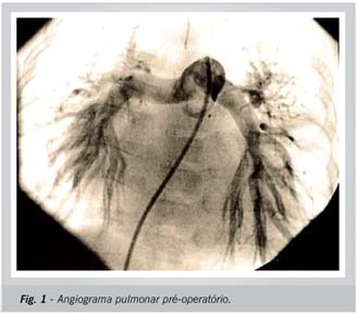 Defeito completo do septo atrioventricular com cianose