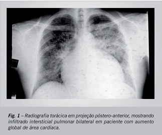The importance of amiodarone pulmonary toxicity in the differential diagnosis of a patient with dyspnea awaiting a heart transplant