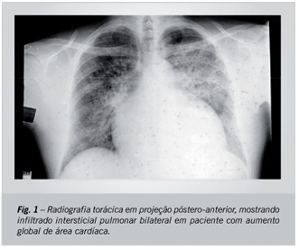 Importância da toxicidade pulmonar pela amiodarona no diagnóstico diferencial de paciente com dispnéia em fila para transplante cardíaco