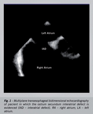 Three-dimensional transesophageal echocardiography in a patient with Ostium Secundum interatrial defect