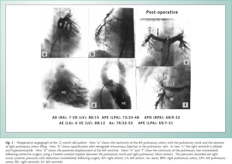 Isolated unilateral pulmonary artery agenesis: evaluation of natural and long term evolution after corrective surgery