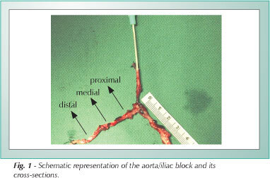 Vascular radiolesion as a deleterious effect of high-dose-rate intraarterial brachytherapy with Samarium-153 in hypercholesterolemic rabbits