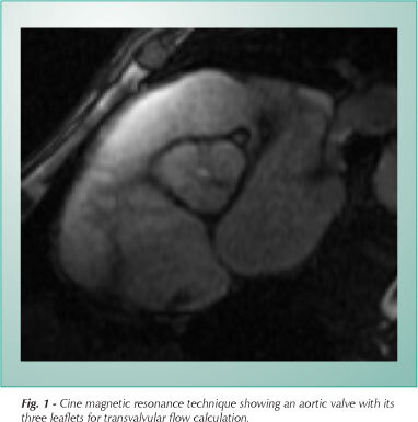 Magnetic resonance imaging is image diagnosis in heart valve disease