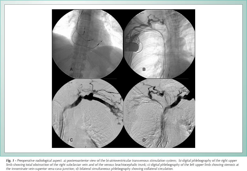 Bi-atrial subxiphoid epicardial pacemaker in superior vena cava syndrome