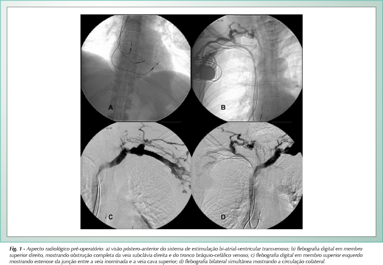 Marcapasso bi-atrial epicárdico subxifóide na obstrução da veia cava superior