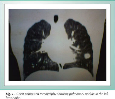 Post-transplantation lymphoproliferative disorder in pediatric patient