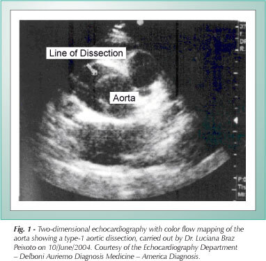 Acute aortic dissection during pregnancy