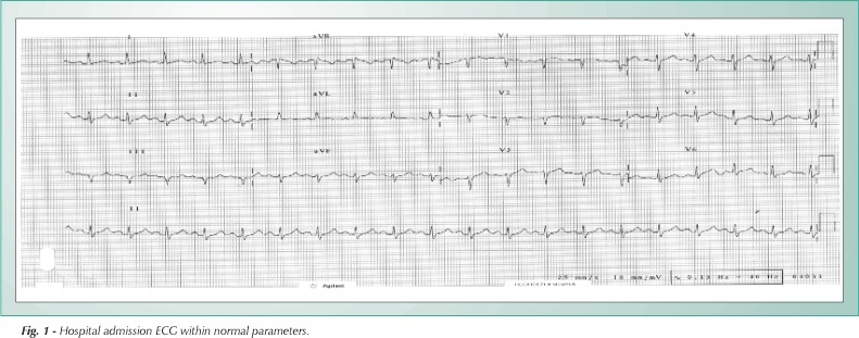 A rare association of systemic lupus erythematosus, morbid obesity and Takotsubo Syndrome