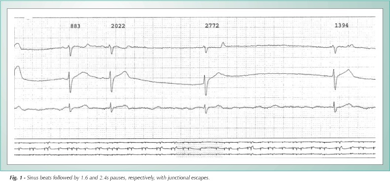 Sinus node dysfunction in a patient with left atrial isomerism