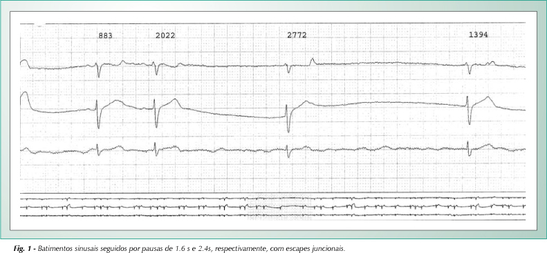 Disfunção sinusal em paciente com isomerismo atrial esquerdo