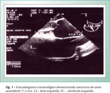 Tratamento cirúrgico de aneurisma de aorta ascendente: observação ecocardiográfica simultânea dos óstios coronarianos reimplantados em prótese vascular