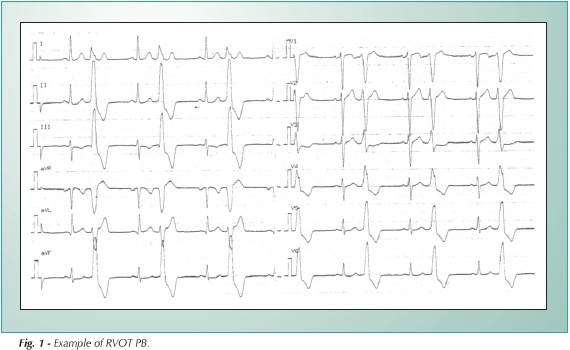 Syncope in patients with right ventricle outflow tract premature beats and no apparent structural cardiopathy