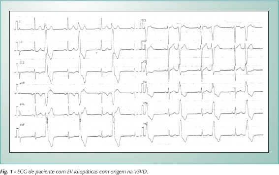 Síncope em pacientes com extra-sístoles de via de saída de ventrículo direito e sem cardiopatia estrutural aparente