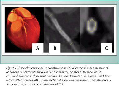 Late outcome of sirolimus-eluting stents: comparison of multidetector computed tomography with quantitative coronary angiography and intravascular ultrasound
