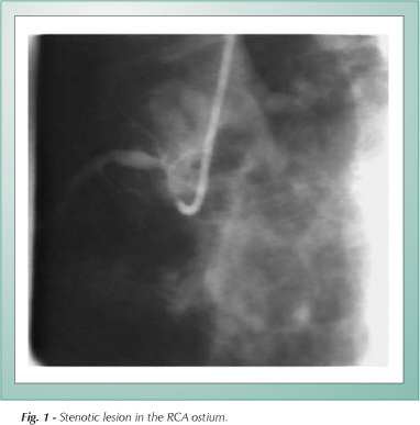 In-hospital and late outcomes after coronary stenting in patient with unstable angina and myelodysplastic syndrome