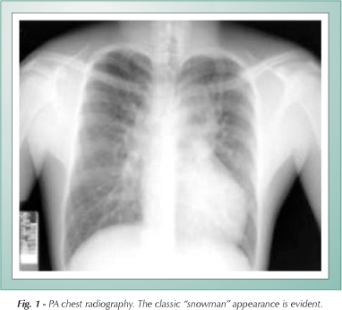 Surgical correction of total anomalous pulmonary venous drainage in an adult