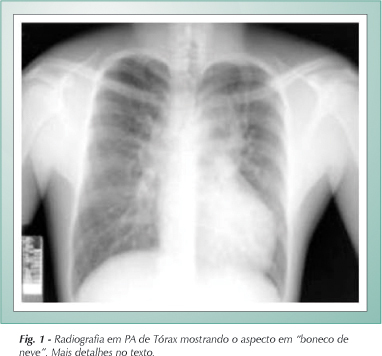 Correção cirúrgica de drenagem venosa pulmonar anômala total em adulto