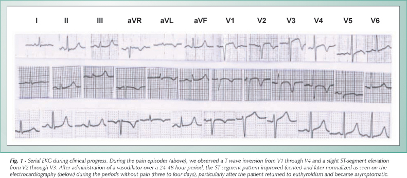 Angina pectoris in patient with hyperthyroidism and normal angiography coronary