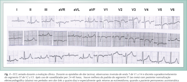 Angina pectoris em paciente com hipertireoidismo e coronárias angiograficamente normais