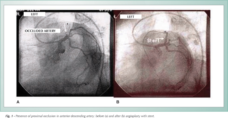 Myocardial infarction associated with the use of a dietary supplement rich in ephedrine in a young athlete