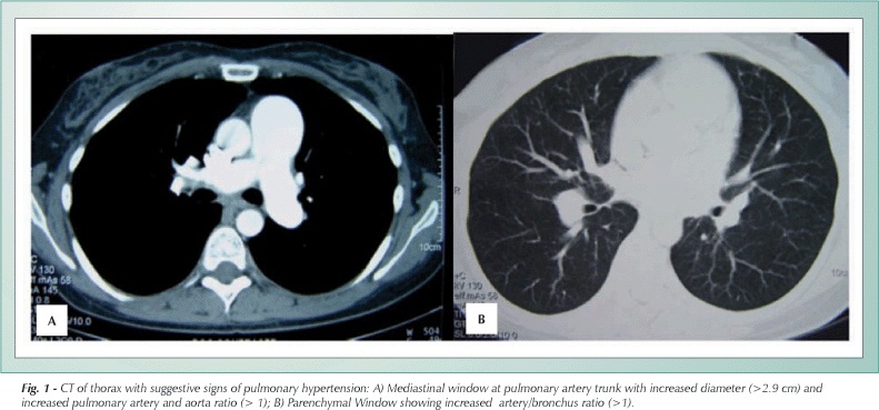 Tadalafil as treatment for idiopathic pulmonary arterial hypertension