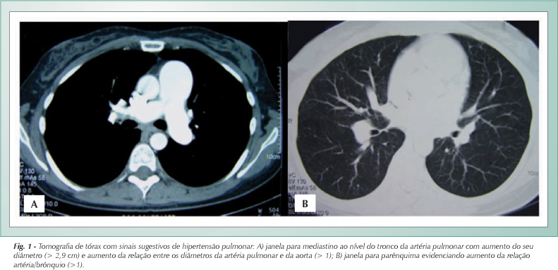 Tadalafil para o tratamento da hipertensão arterial pulmonar idiopática