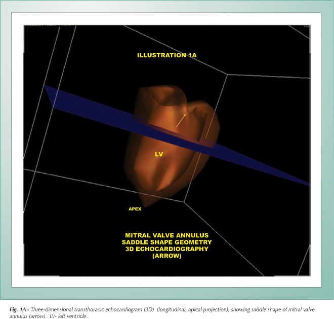 Saddle shape of mitral valve annulus: three-dimensional transthoracic echocardiography
