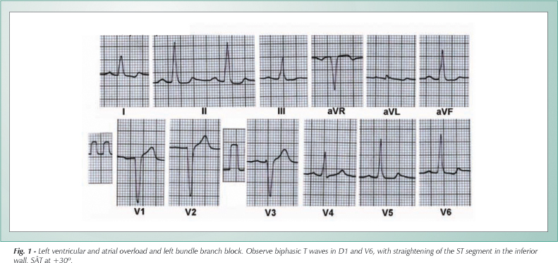 Progression of ventricular repolarization in left bundle branch block in non-compaction of the myocardium