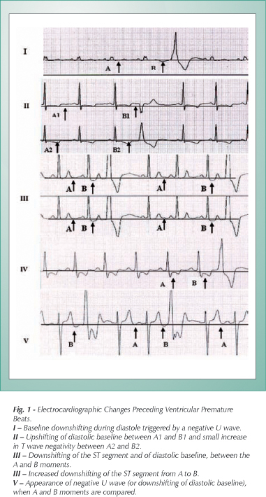 Electrocardiographic abnormalities preceding ventricular premature beats