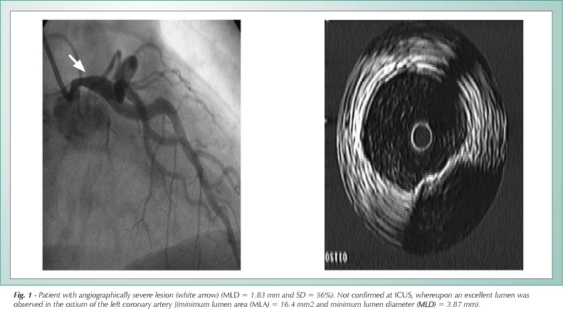The usefulness of intracoronary ultrasound in the treatment decision-making of patients with ambiguous lesions in the left main coronary artery