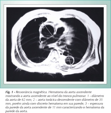 Hematoma da aorta ascendente