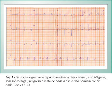 Ruptura do septo interventricular após trauma torácico fechado