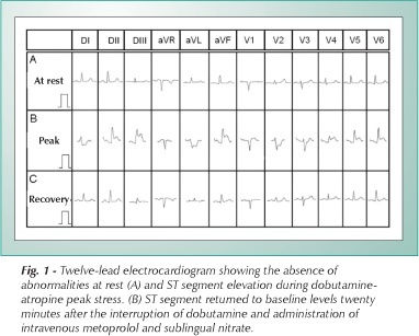 Coronary spasm induced by dobutamine-atropine stress echocardiography