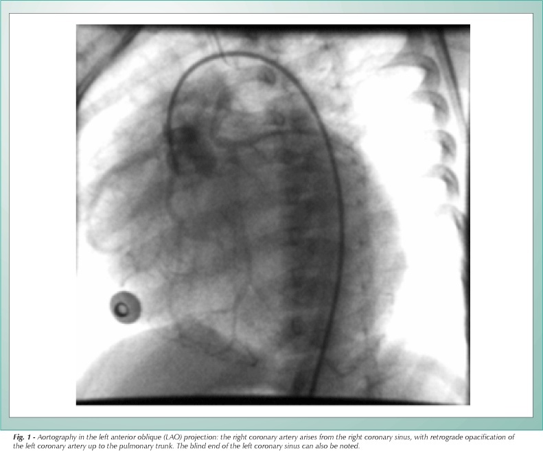 Anomalous origin of the left coronary artery from the pulmonary trunk