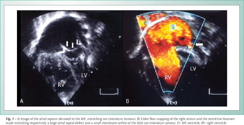 Total anomalous pulmonary venous connection and a restrictive foramen ovale, with left-sided deviation of the atrial septum mimicking left-sided cor triatriatum: echocardiographic misdiagnosis
