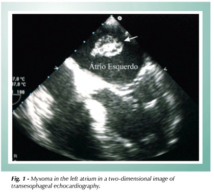 Left atrial myxoma associated with obstructive coronary artery disease