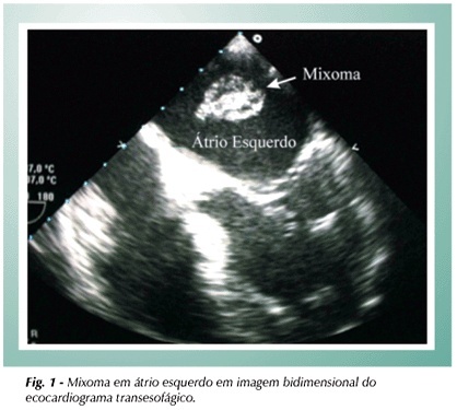 Mixoma em átrio esquerdo associado a doença arterial coronariana obstrutiva