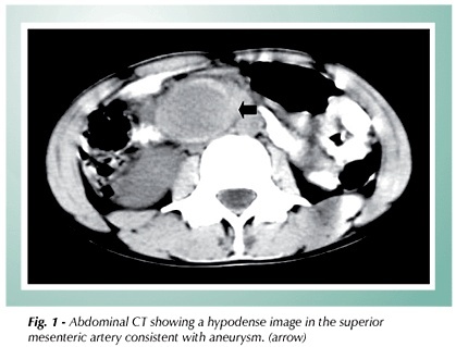 Abdominal mycotic aneurysm and cerebral embolic event associated with infective endocarditis in a patient with chronic rheumatic valvar disease