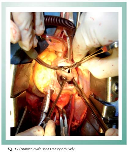 Right to left shunt through a patent foramen ovale without pulmonary hypertension