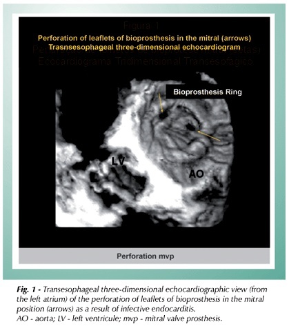 Three-dimensional transesophageal echocardiographic imaging of mitral valve bioprosthesis leaflets perforation due to infective endocarditis
