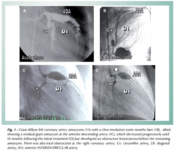 Kawasaki disease: giant coronary arteries aneurysms regression and later stenosis
