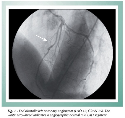 Severe coronary milking in obstructive hypertrophic cardiomyopathy