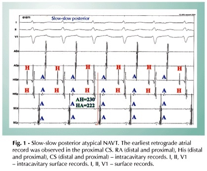 Contribution of the electrophysiological and anatomical analysis of the atypical atrioventricular nodal tachycardia circuit