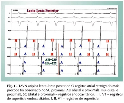 Contribuição da análise eletrofisiológica e anatômica do circuito atípico da taquicardia atrioventricular nodal