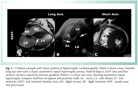 Cardiovascular magnetic resonance in hypertrophic cardiomyopathy