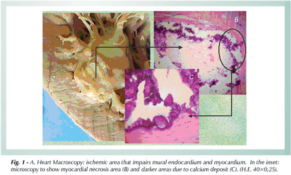 Cardiovascular complications in a child with chronic renal failure