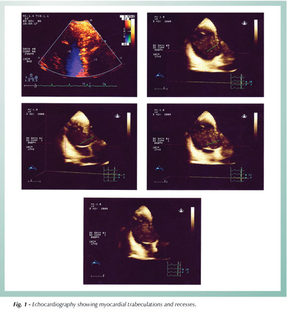 Isolated noncompaction of the myocardium