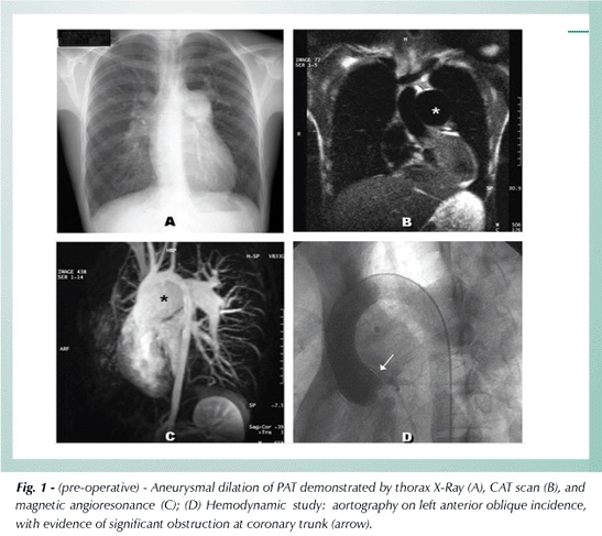 Extrinsic compression of left main coronary artery from aneurysmal dilation of pulmonary trunk in a adolescent: involution after surgery occlusion of sinus venosus atrial septal defect and pulmonary trunk plasty for reduction